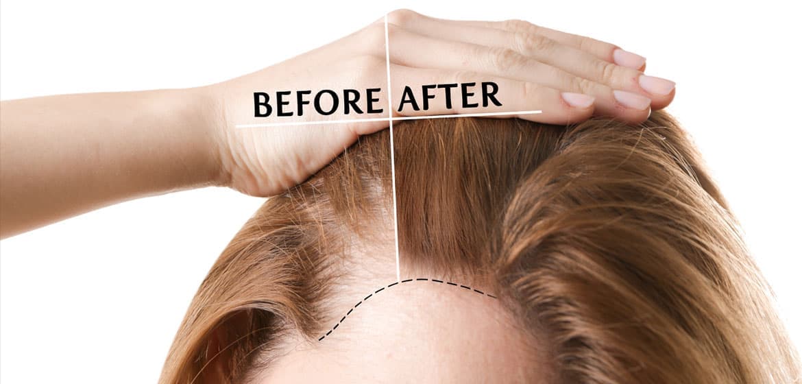 Hair Transplant Turkey: Restore Your Hair Without Complications