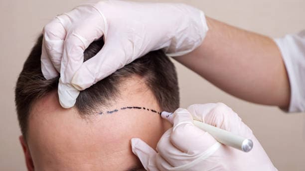 Hair Transplant Price Comparison: Turkey, UK, USA &amp; Europe