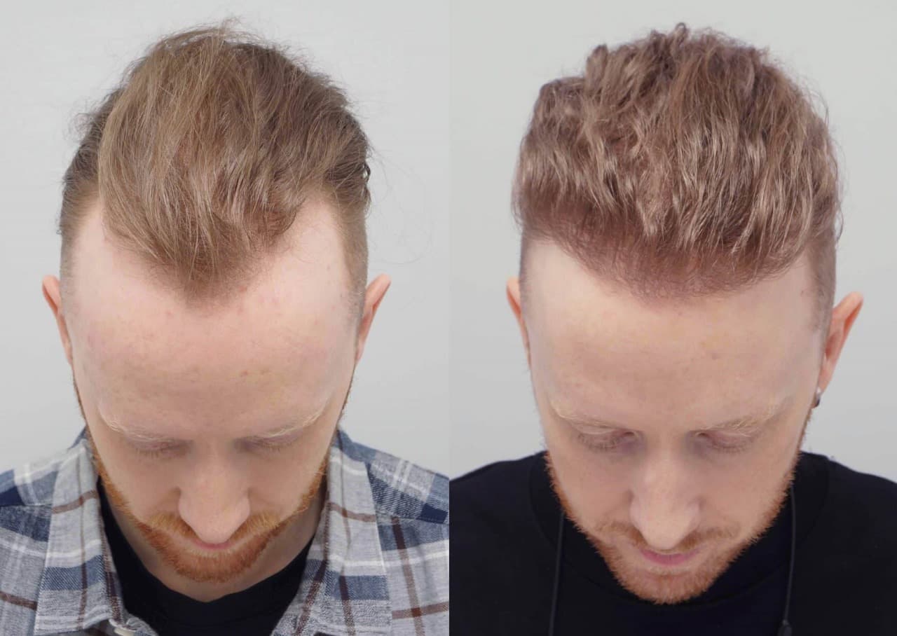 Hair Transplant London – Trusted Solutions for Hair Loss