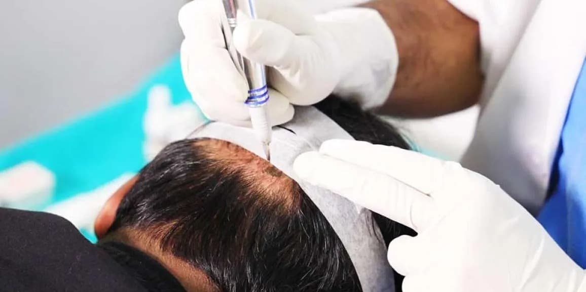 Hair Transplant Turkey: Step-by-Step Guide for First-Time Patients