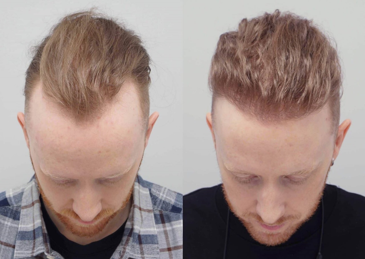 Hair Transplant London – Trusted Solutions for Hair Loss